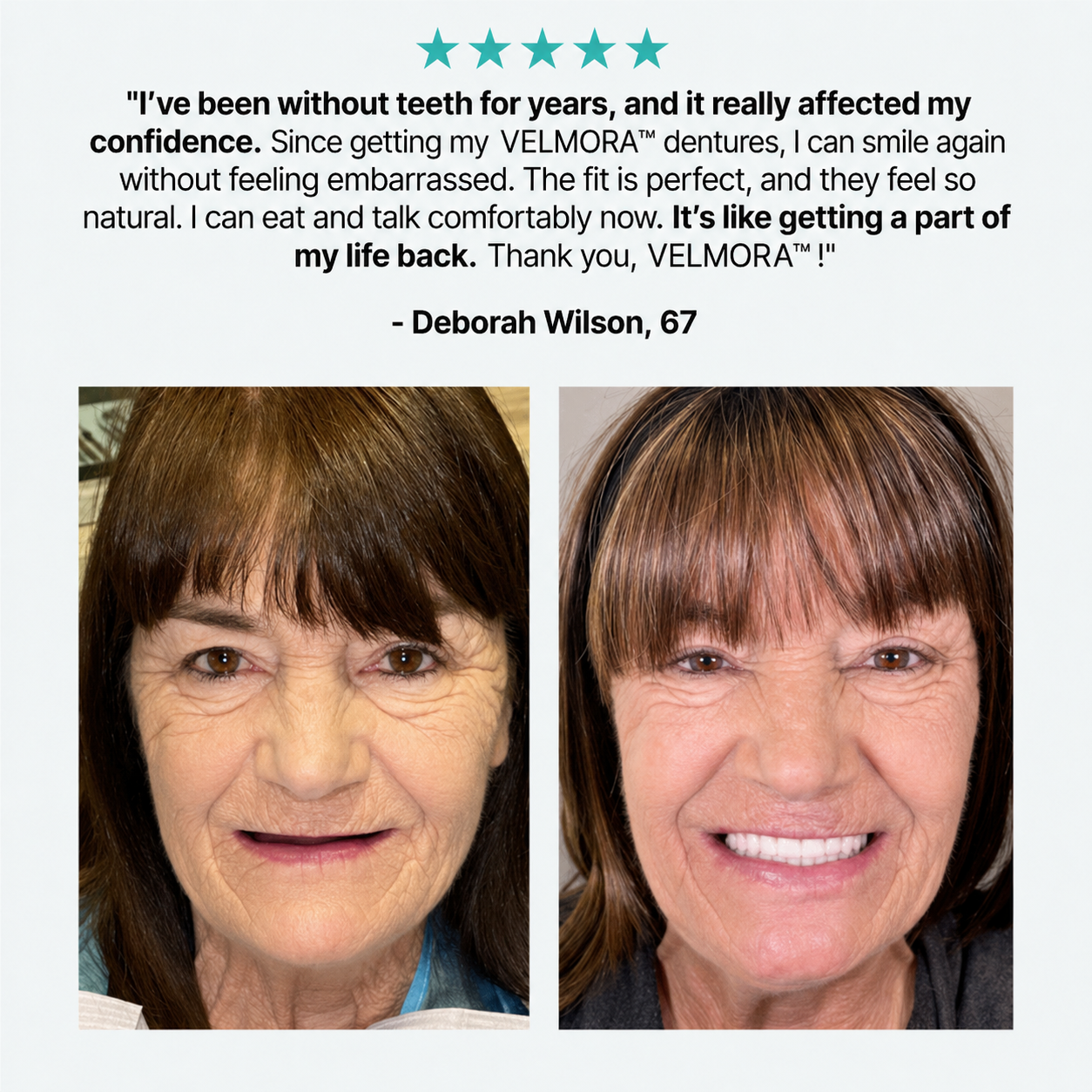 👑 Mother's Day Blowout: 70% OFF Ends Tonight! 🏆 Custom-Fit Dentures | Smile with Confidence
